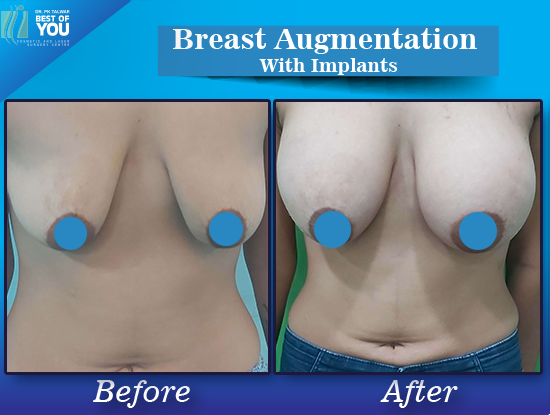 Breast Augmentation with implant result